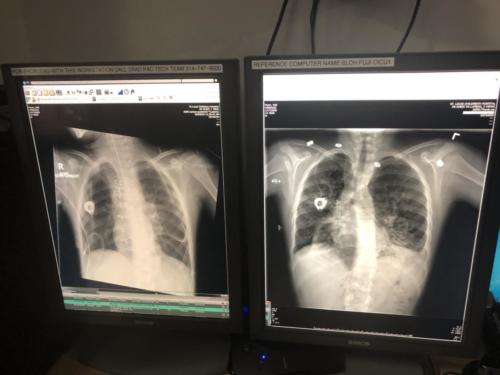 New lungs on the left 